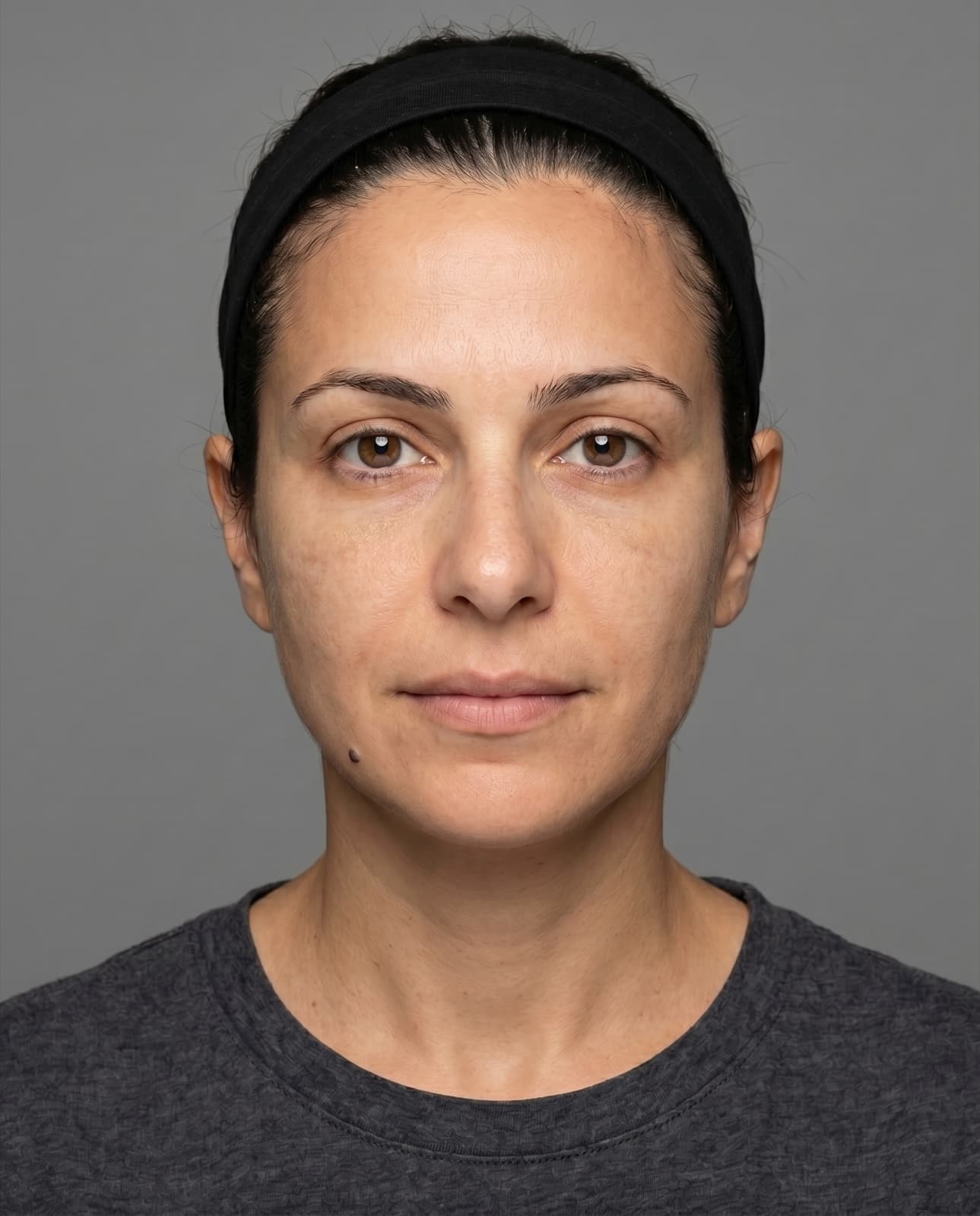 Melasma and sun-induced pigmentation
