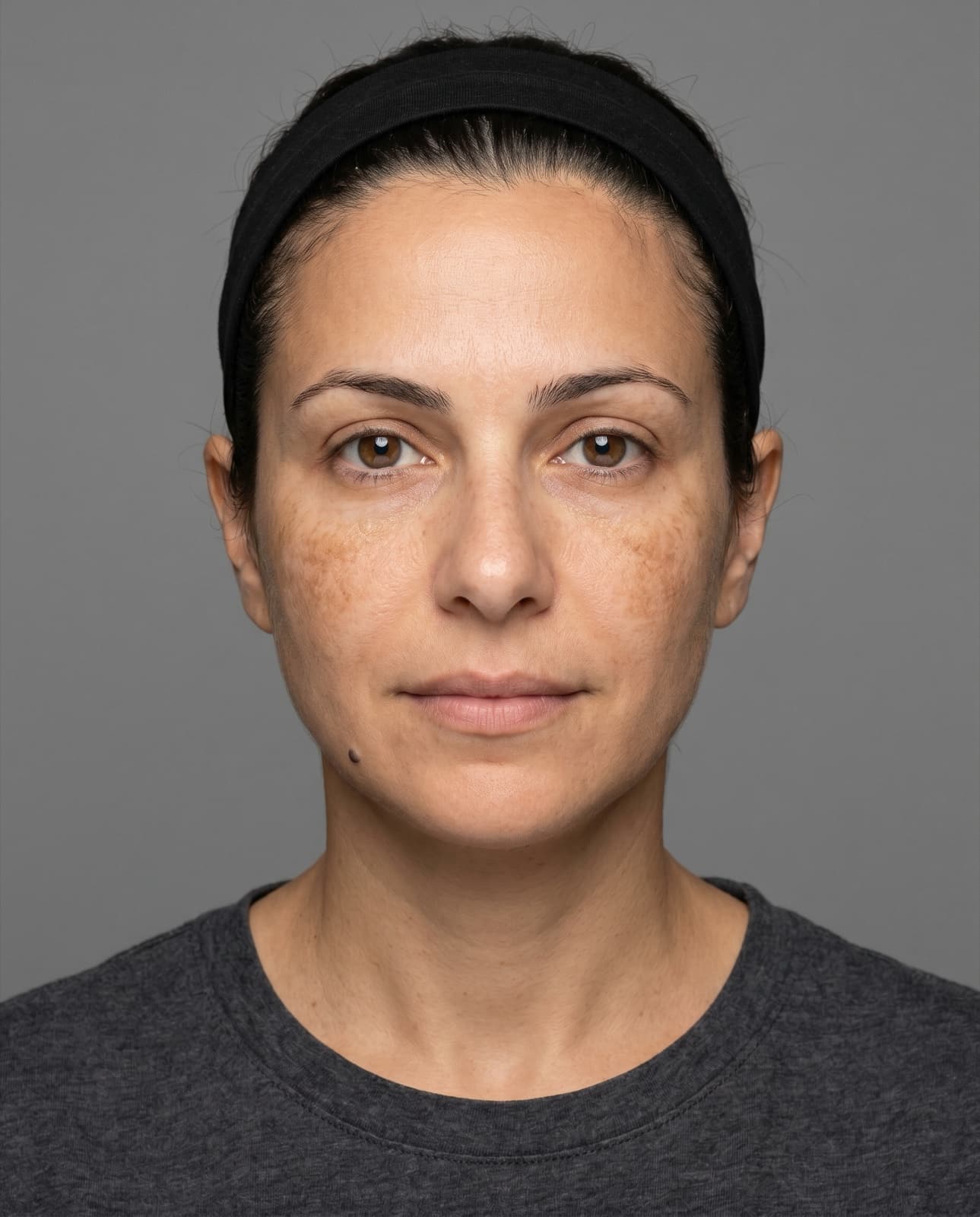 Melasma and sun-induced pigmentation
