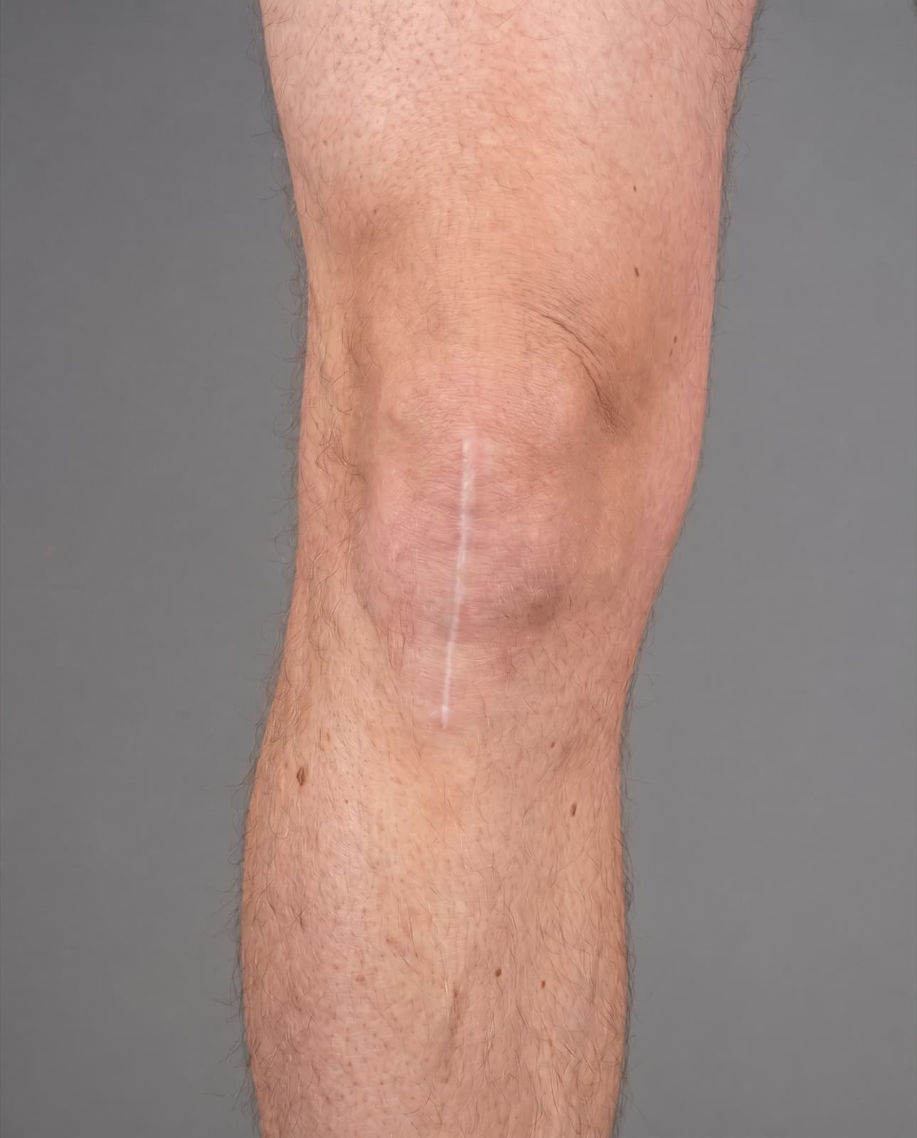 Surgical scars
