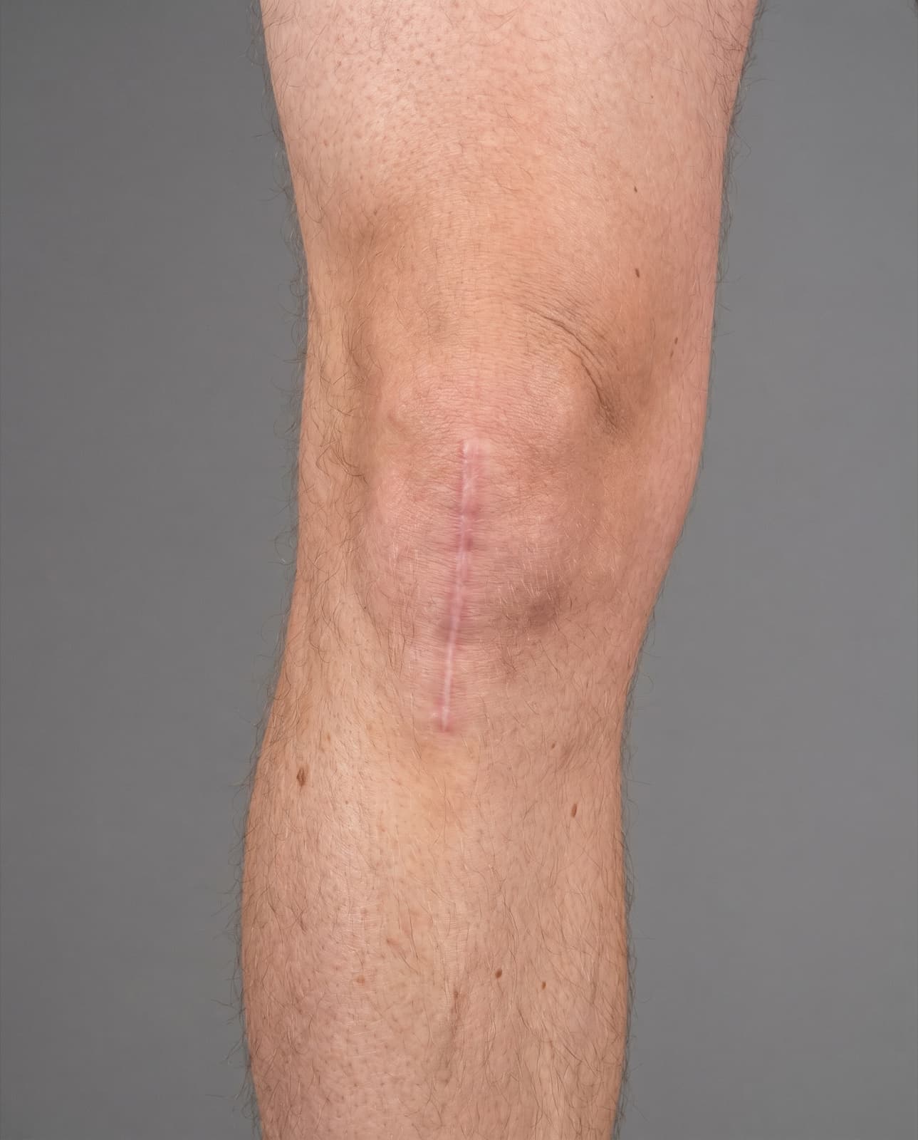 Surgical scars
